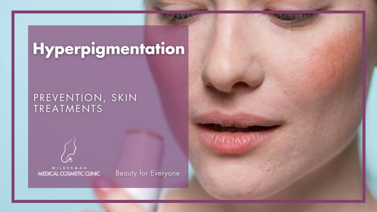 Hyperpigmentation: Prevention, Skin Treatments | Wilderman Cosmetic