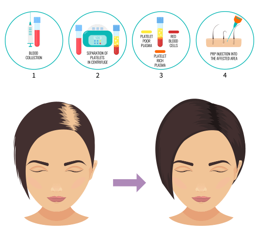 Cartoony illustration of Personalized PRP Boost Hair Growth