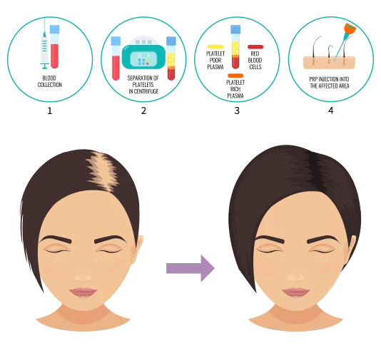 Personalized PRP Boost Hair Growth Cartoony illustration of Personalized PRP Boost Hair Growth