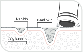 OxyGeneo ™ exfoliates the upper skin layer to remove dead skin cells