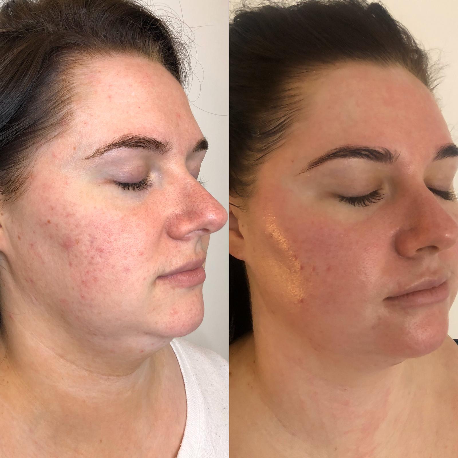 Exfoliating acids - Photo of woman before and after the procedure 