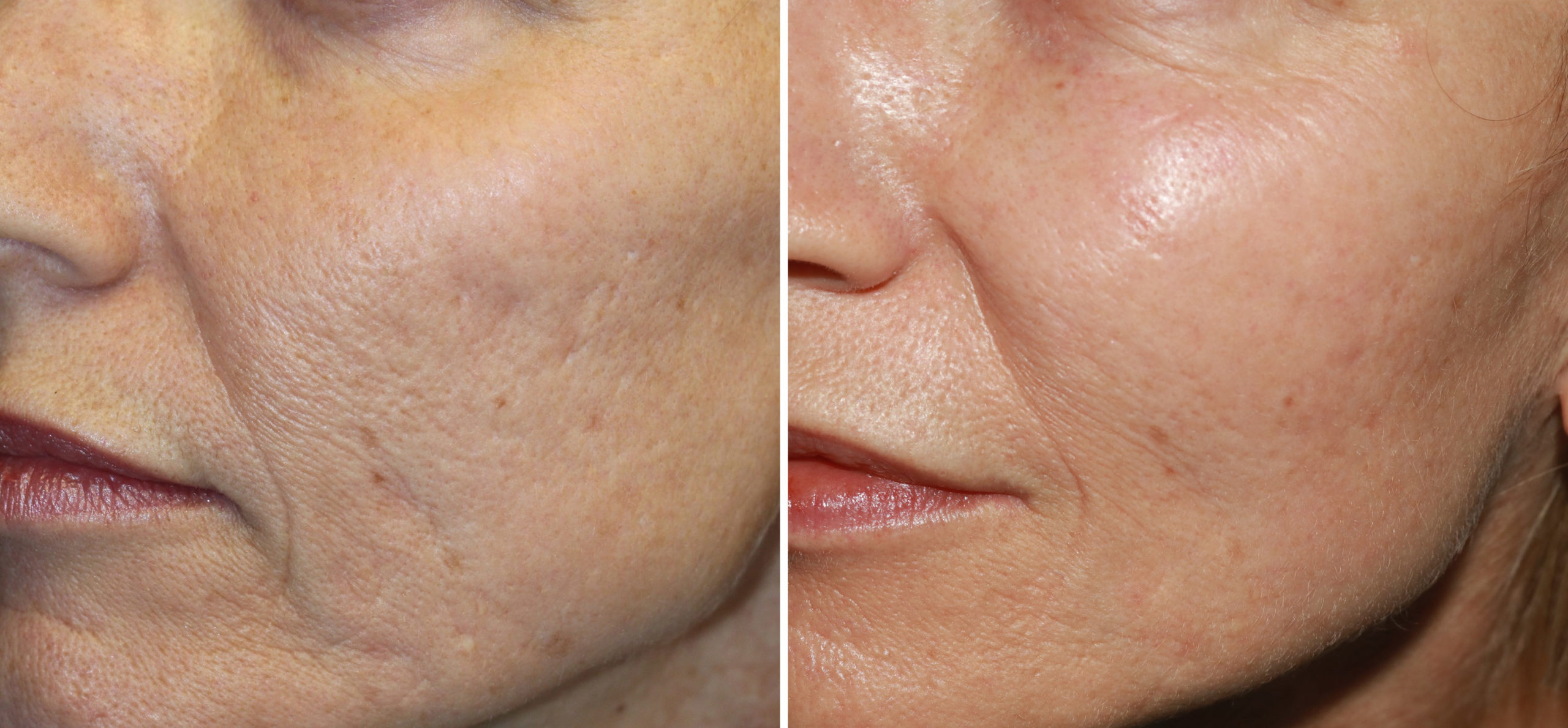 Microneedling - Picture of a woman before and after the treatment