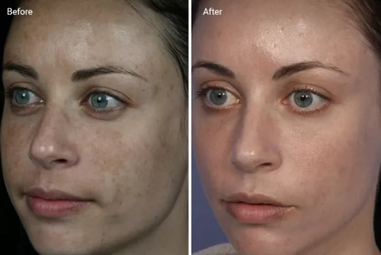 How BBL works - Image of a woman Before and After the BBL treatment