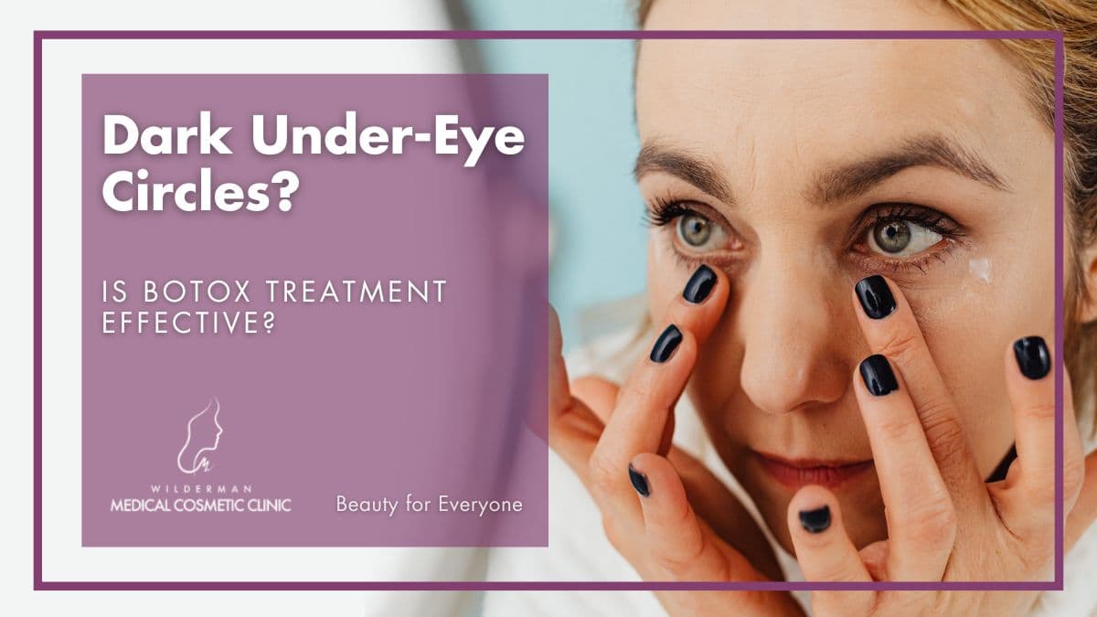 Dark Under-Eye Circles: Is Botox treatment Effective?