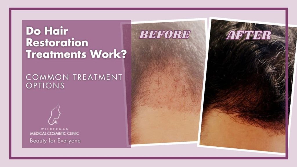 Do Hair Restoration Treatments Work: Common treatment options