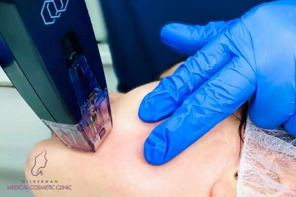 Close-up image of a patient receiving Morpheus8 face treatment, by Medical Aesthetician / Injector Arash.