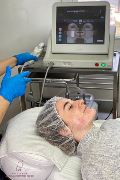 Image of a patient finishing Ultherapy treatment on various areas of the face, by Dr. Arash.