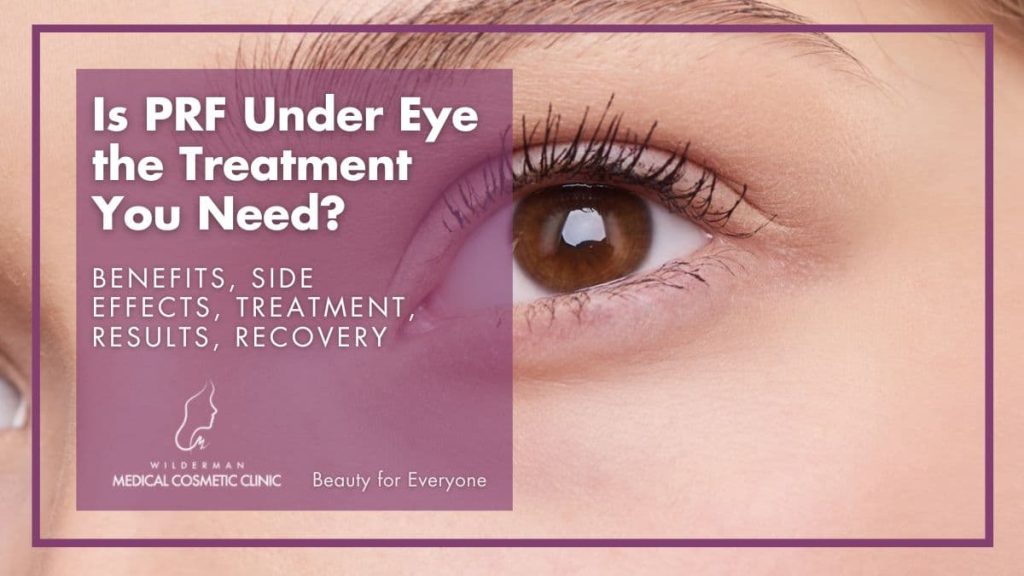 Is PRF Under Eye the Treatment you Need? - Benefits, Side effects, treatment, Results, recovery 