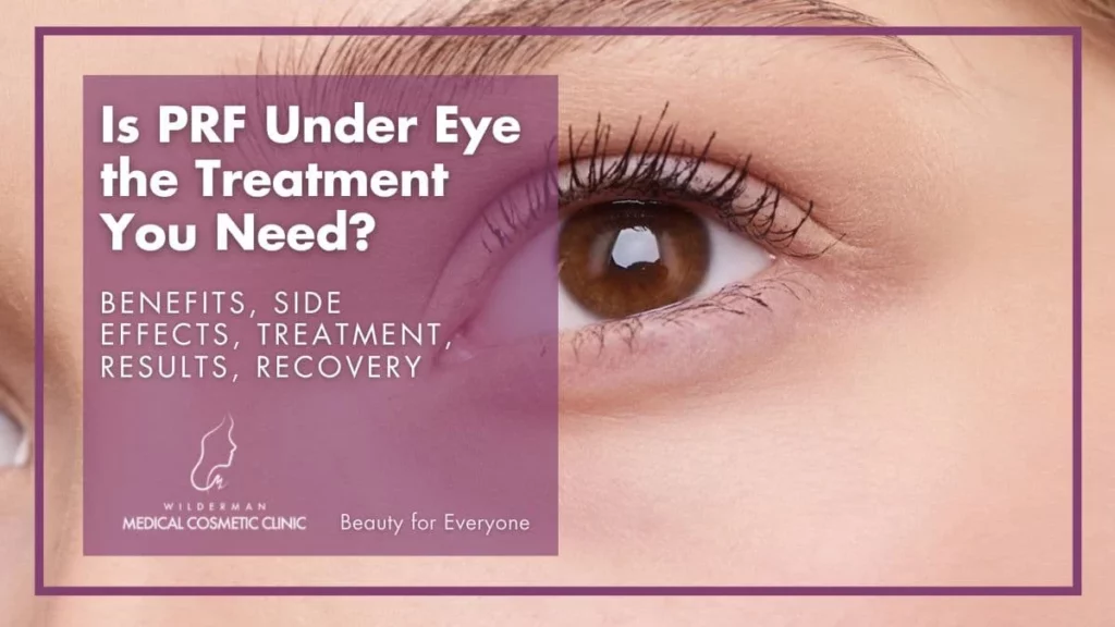 Is PRF Under Eye the Treatment you Need? - Benefits, Side effects, treatment, Results, recovery 