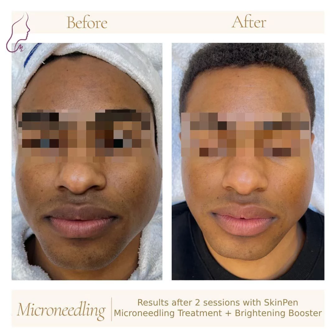 Is Microneedling right for you?