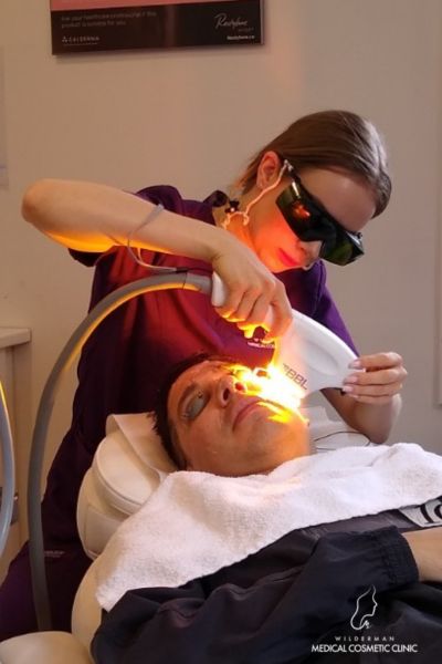 Image of a patient receiving BBL treatment on various areas of the face, by Medical Aesthetician / Injector Victoria.