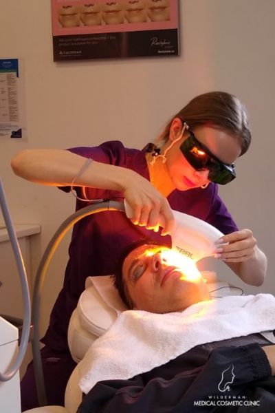 Closer-up image of a patient receiving BBL treatment on areas of the face, by Medical Aesthetician / Injector Victoria.