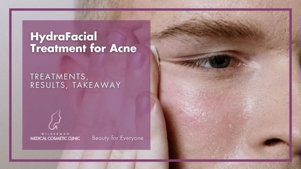 –HydraFacial-Treatment-for-Acne-WMCC– HydraFacial Treatment for Acne: Treatments, Results, Takeaway