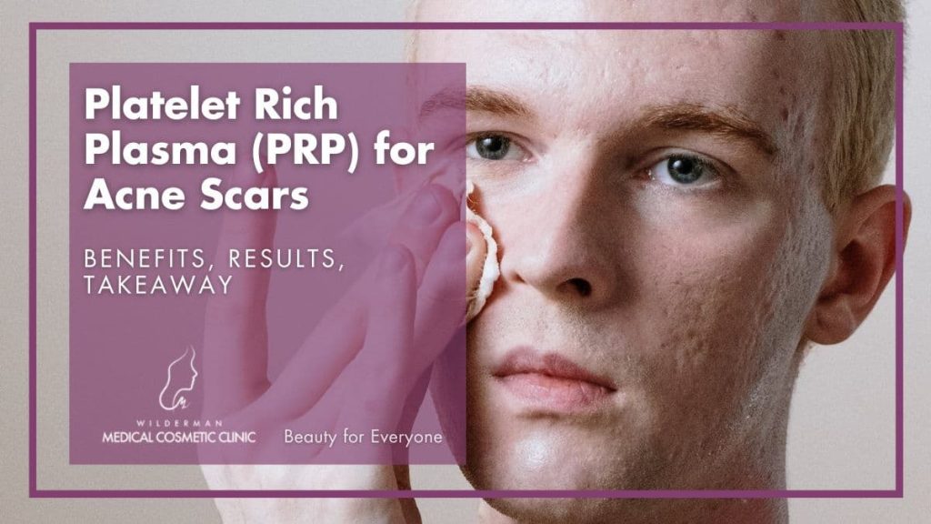 Platelet Rich Plasma (PRP) for Acne Scars: Benefits, Results, Takeaway