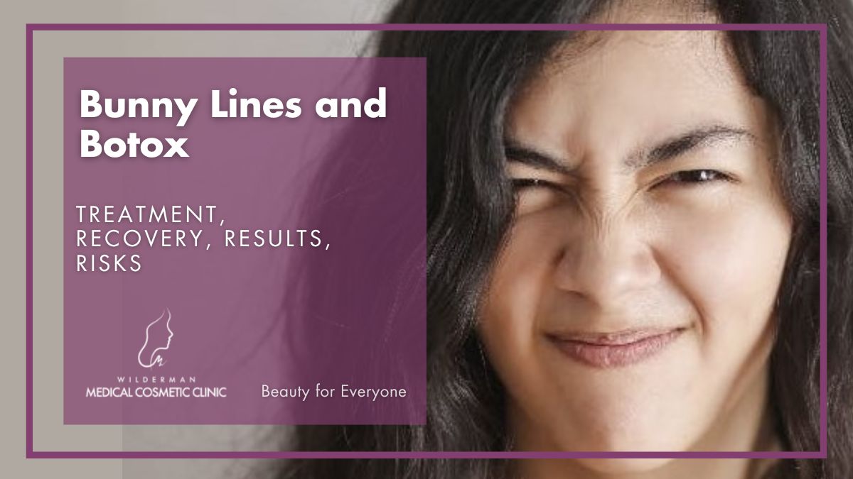 Bunny Lines and Botulinum Toxin: Treatment, Recovery, Results, Risks - Wilderman Medical Cosmetic Clinic