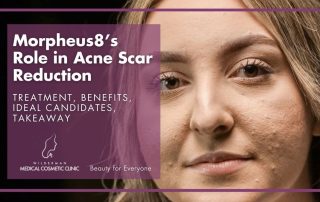 Morpheus8’s Role in Acne Scar Reduction: Treatment, Benefits, Ideal Candidates, Takeaway