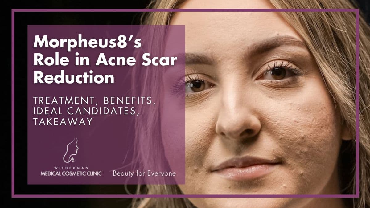 Morpheus8’s Role in Acne Scar Reduction: Treatment, Benefits, Ideal Candidates, Takeaway 