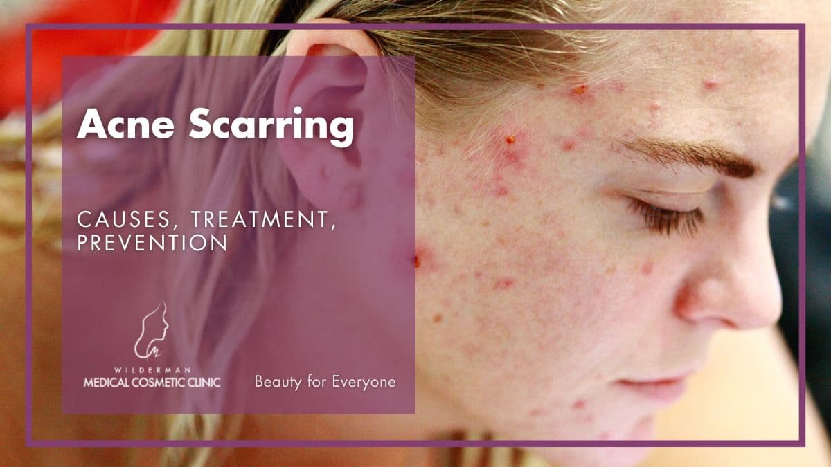 Acne Scarring - Causes, Treatment, Prevention