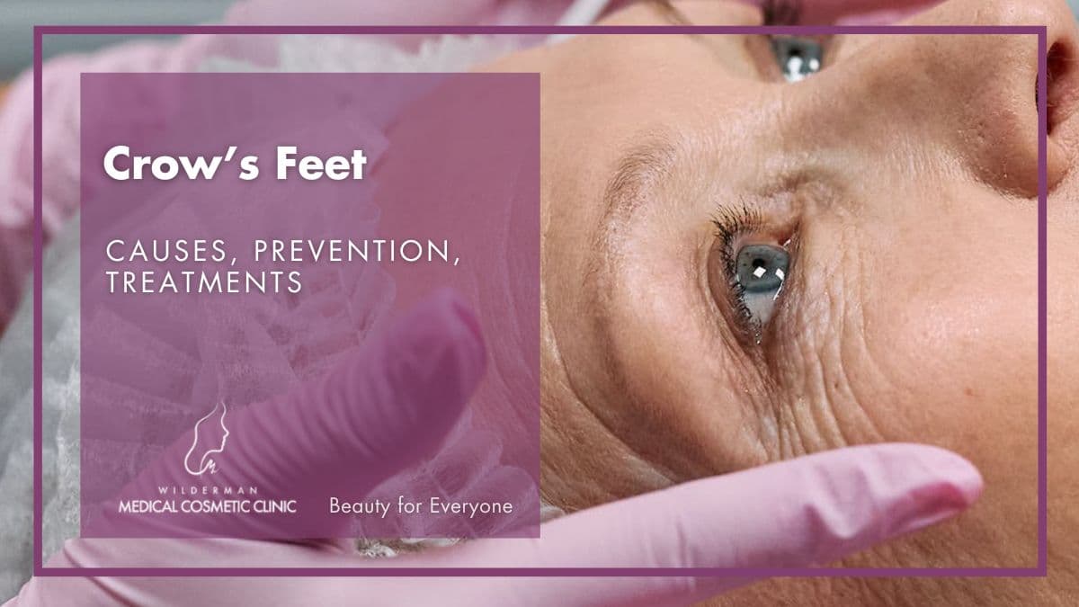 Crow’s Feet: Causes, Prevention, Treatments