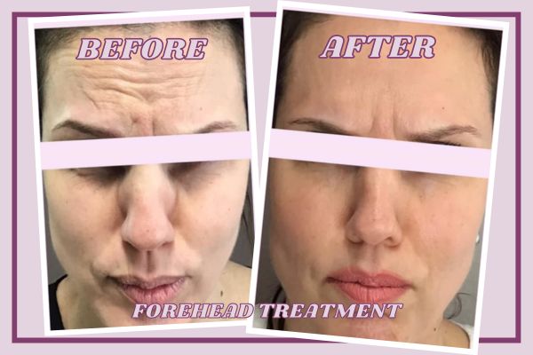 Forehead Lines treatmen: Before and After Results - Wilderman Medical Cosmetic Clinic