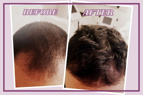 Hair Restoration Treatment Before After