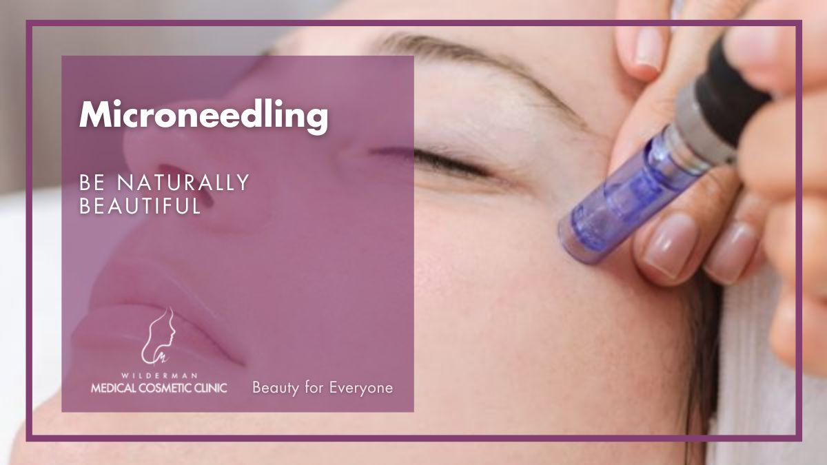 Microneedling - Picture of a woman under treatment