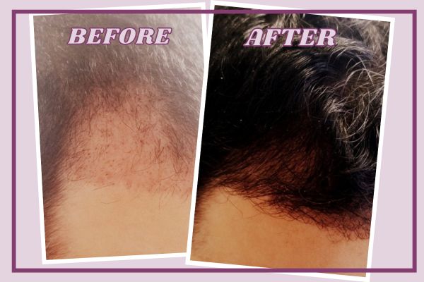 PRP Hair Restoration Treatment Before After