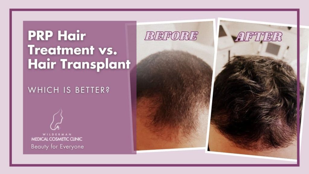 PRP Hair Treatment vs. Hair Transplant: Which is Better? | Wilderman Cosmetic Clinic 