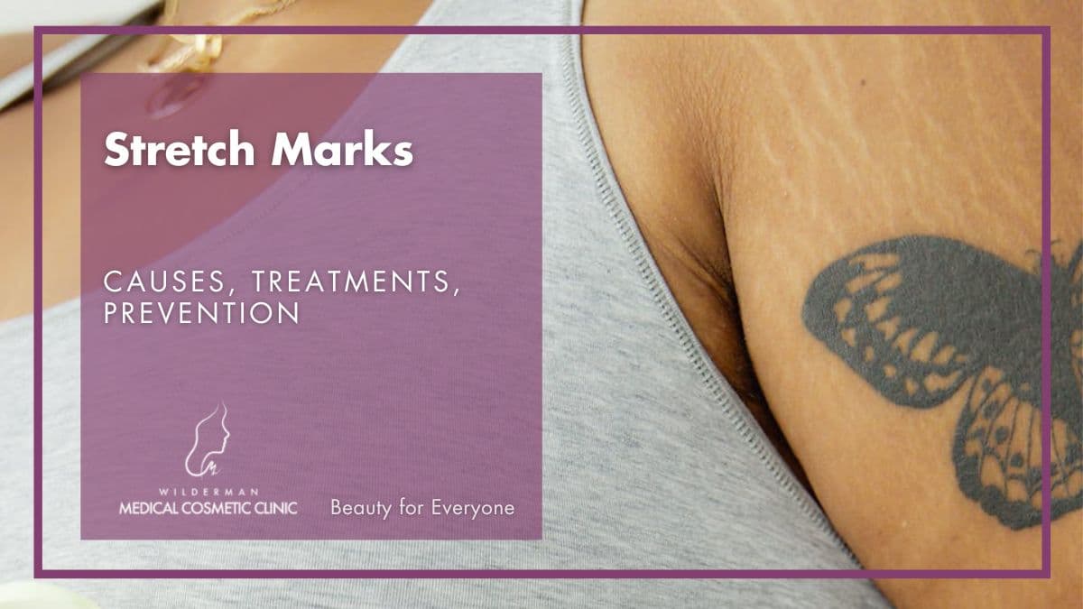 Stretch Marks - Causes, Treatment, Prevention