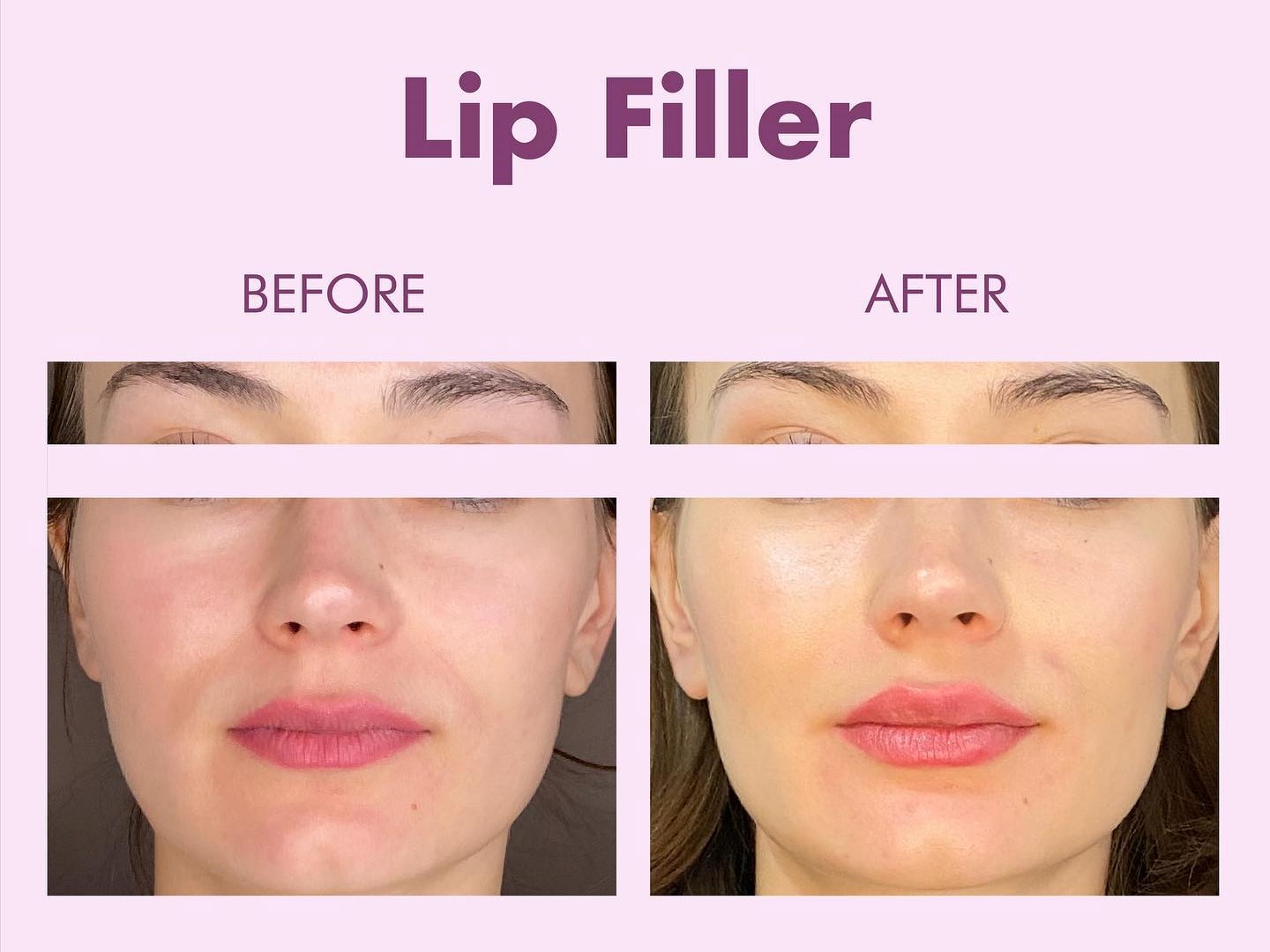 Lip Filler - Before and After pictures from a patient