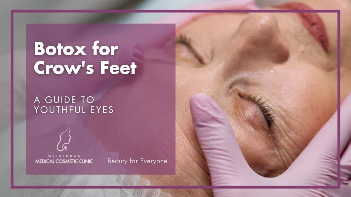 Botox for Crow’s Feet: A Guide to Youthful Eyes | Wilderman Cosmetic Clinic 