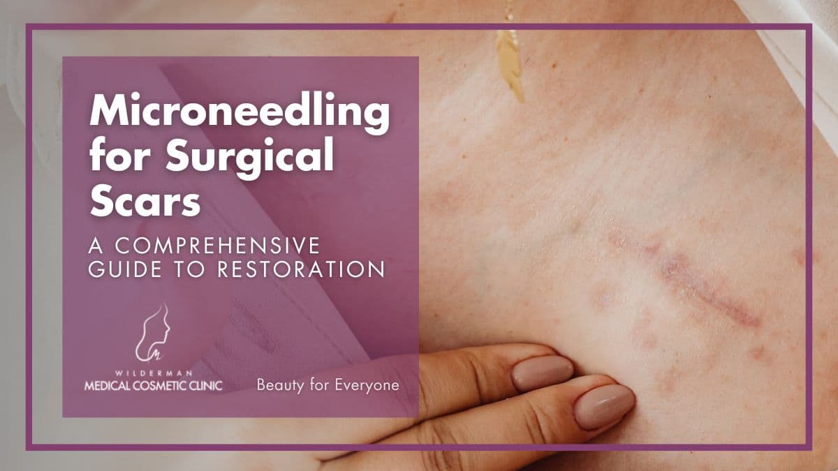 Microneedling for Surgical Scars | Wilderman Cosmetic Clinic 