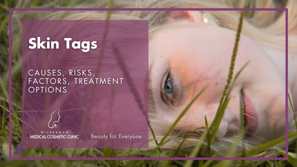 Skin Tags - Causes, Treatment, Prevention
