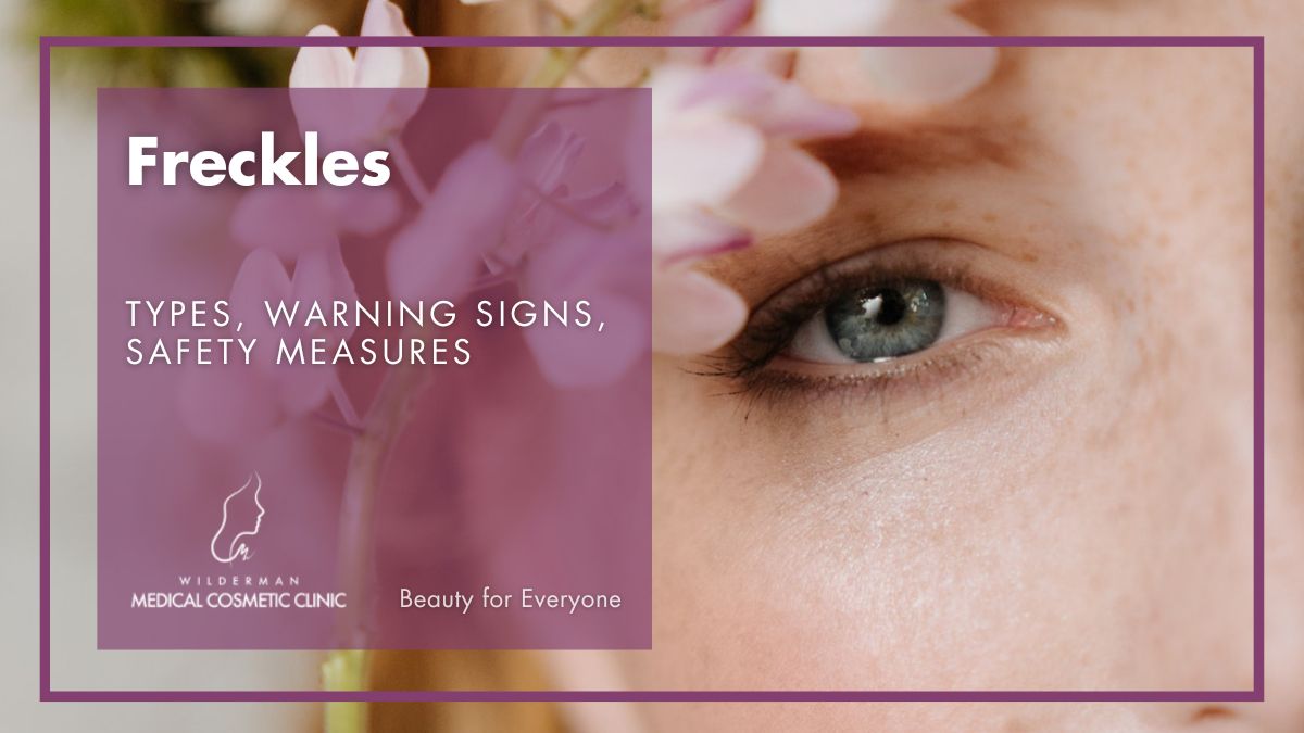 Freckles - Types, Warning Signs, Safety Measures | Wilderman Cosmetic Clinic