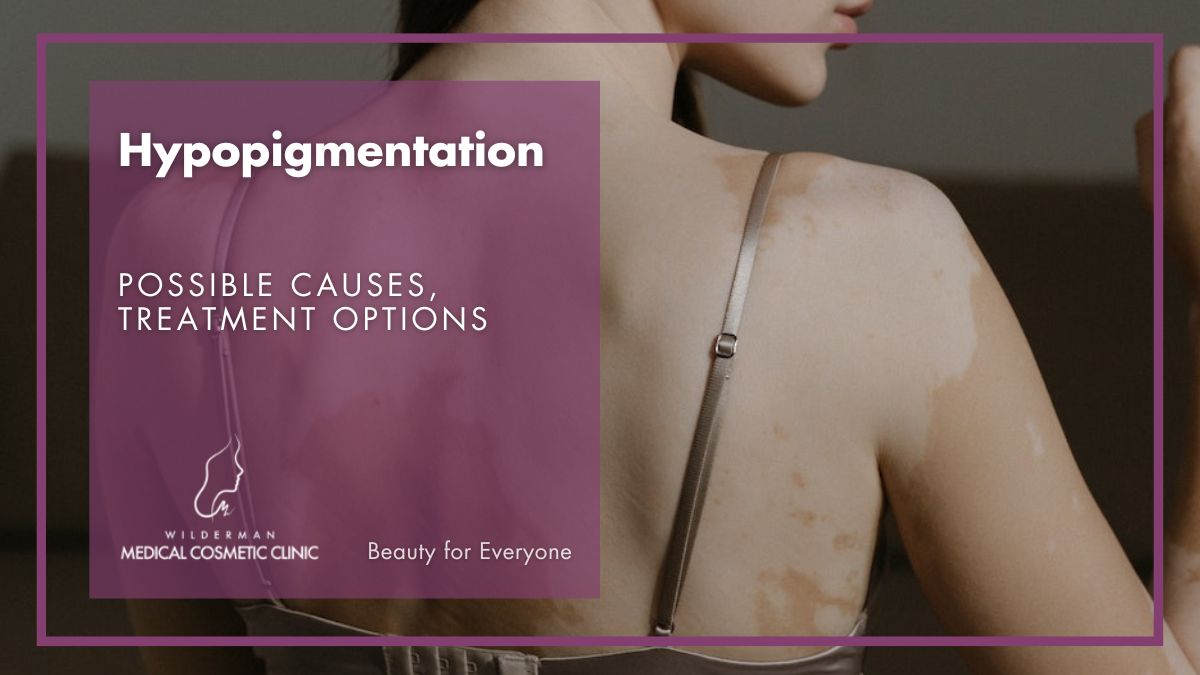 Hypopigmentation: Possible Causes, Treatment Options | Wilderman Medical Cosmetic Clinic