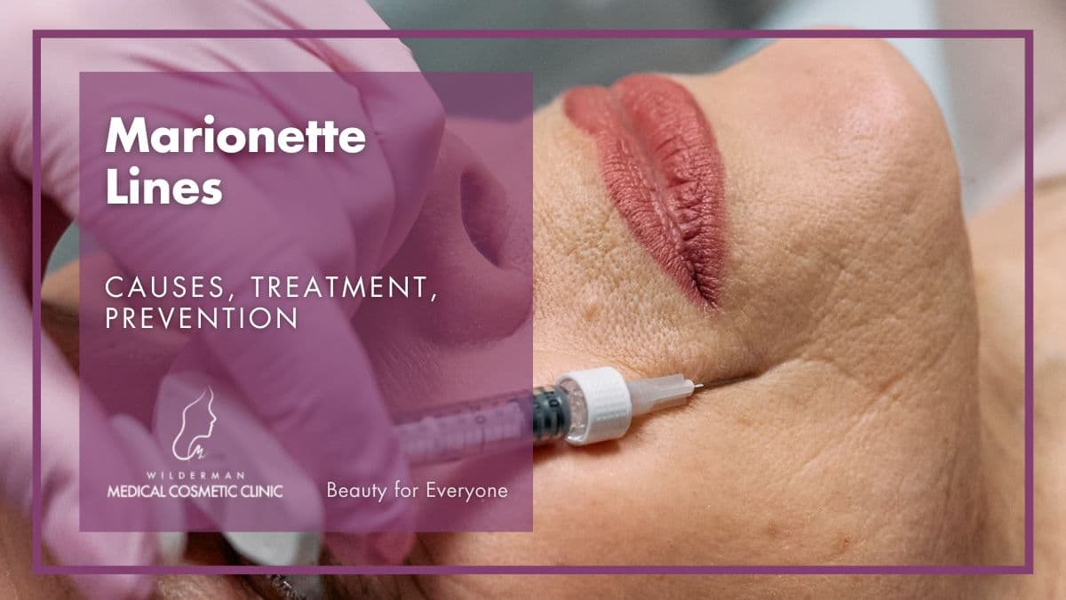 Marionette Lines: Causes, Treatment, Prevention | Wilderman Medical Cosmetic Clinic