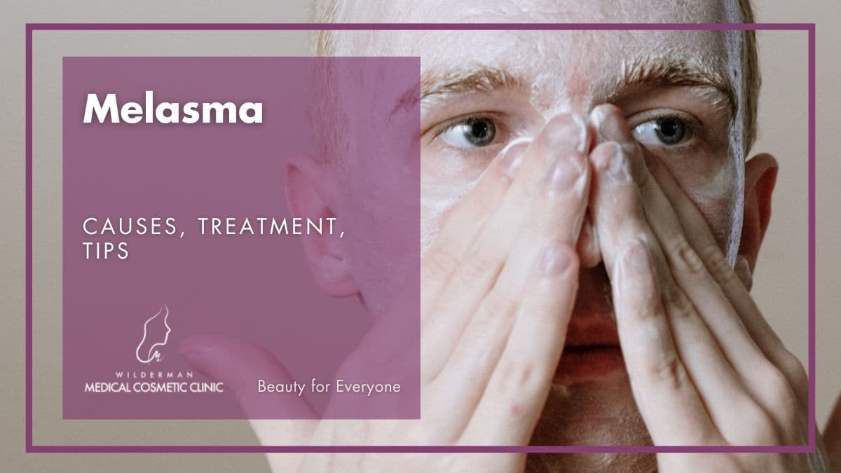 Melasma: Causes, Treatment, Tips | Wilderman Medical Cosmetic Clinic