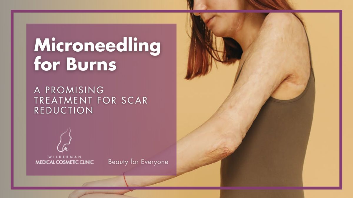 Microneedling for Burns: A Promising Treatment for Scar Reduction | Wilderman Cosmetic Clinic 