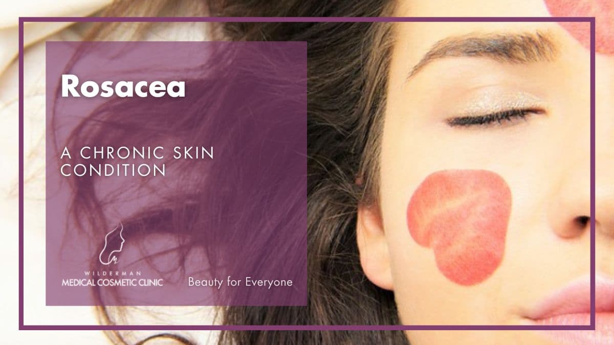 Rosacea: A chronic skin condition | Wilderman Cosmetic Clinic