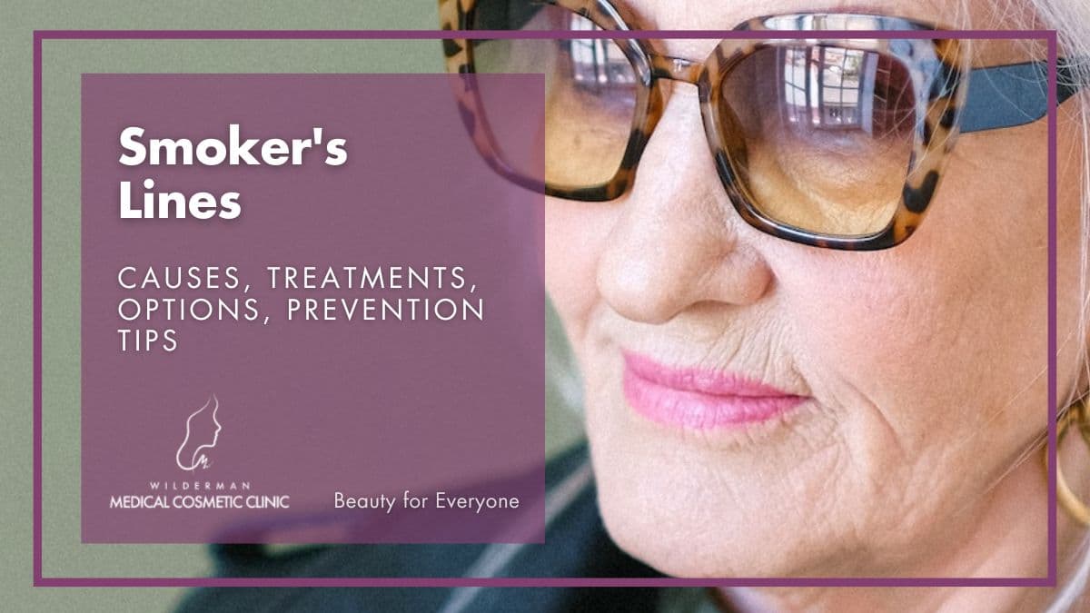 Smoker’s lines: Causes, Treatments, Options, Prevention Tips | Wilderman Medical Cosmetic Clinic