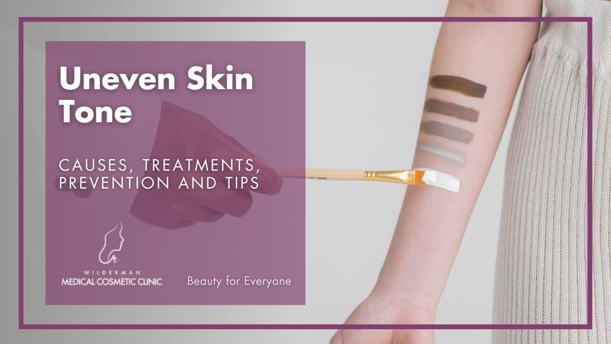 Uneven Skin Tone - Wilderman Cosmetic Clinic 