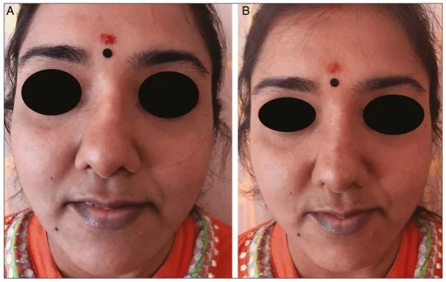 Figure 1: (a)Before the procedure, picture showing a depressed right side of the nose and a bent middle part (dorsal deviation). After the procedure, the picture shows the right side of the nose and middle part fixed.