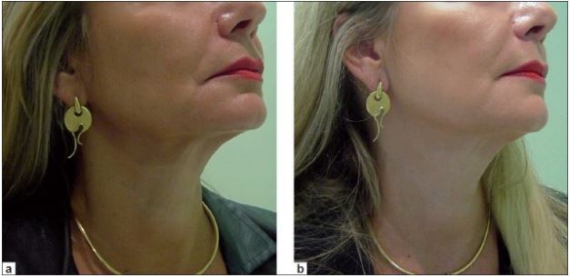 Botox for Mouth Corners: Botox Smile Lift - Wilderman Cosmetic Clinic