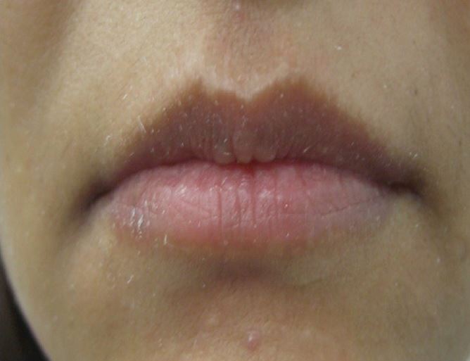 Shaping of upper and lower lips with 1 mL of HA: Pre-treatment