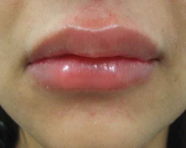 Swelling of the lips immediately after HA injection with needles