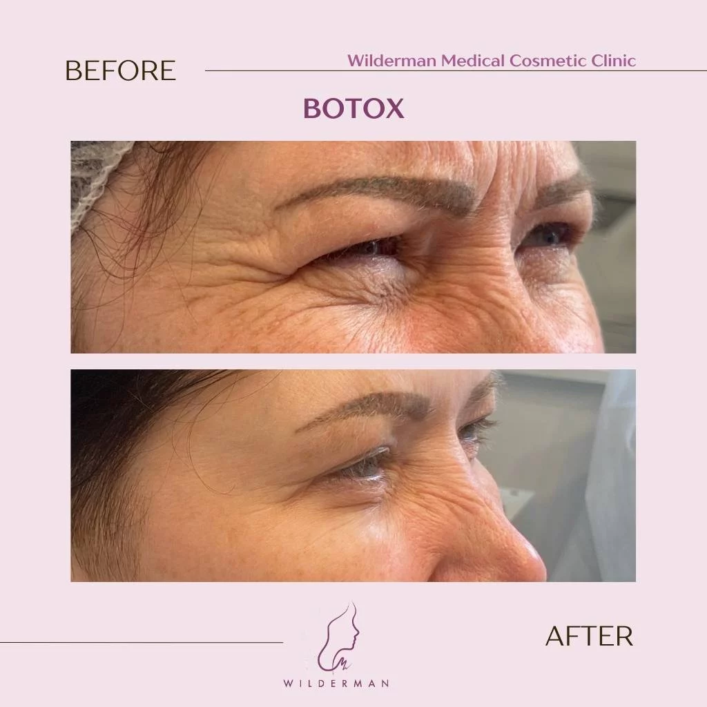 Before and after Botox®
