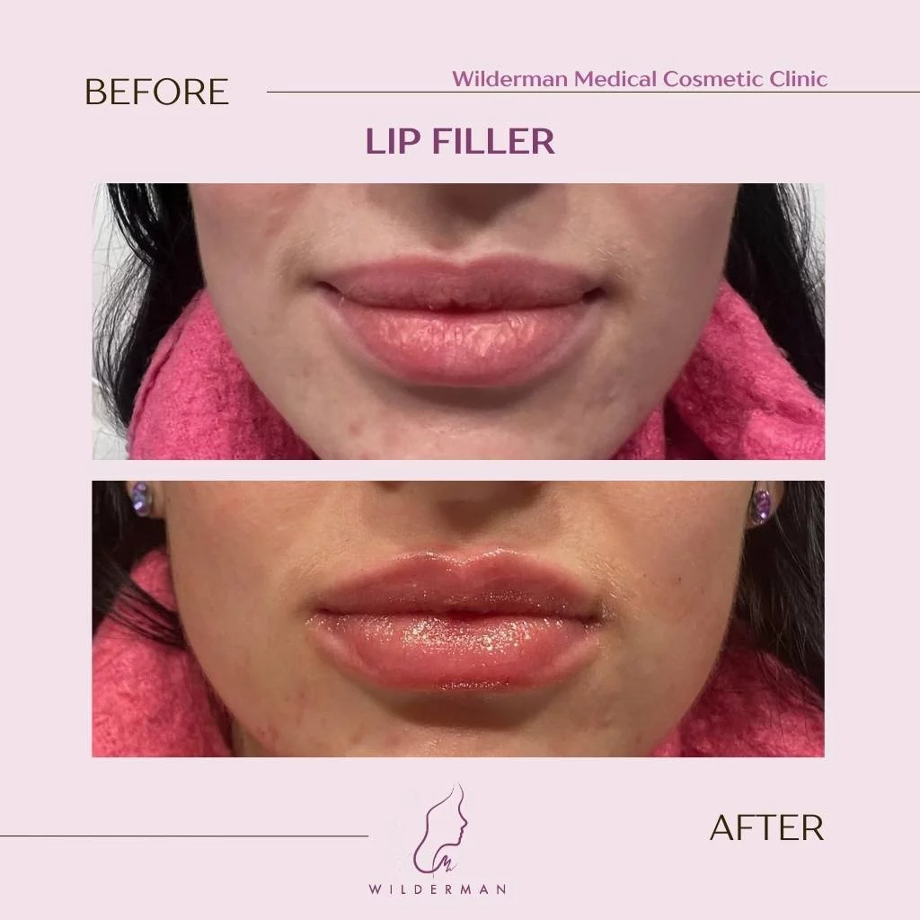 Before and after Lip Filler