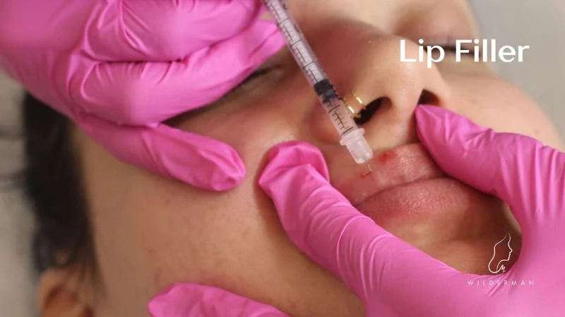 Injecting Lip Filler - wilderman cosmetic clinic