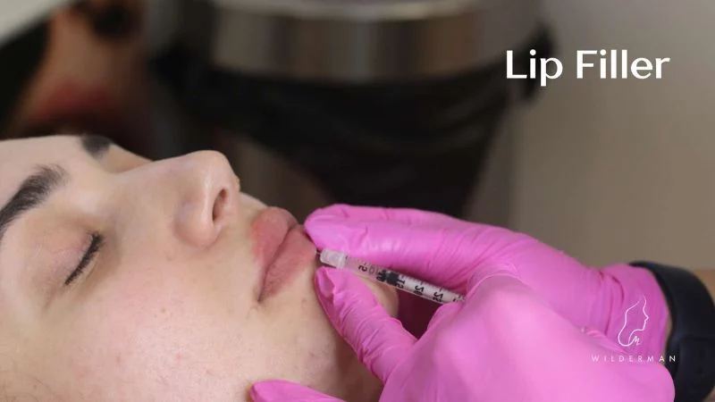 Lip Fillers Injections - wilderman cosmetic clinic