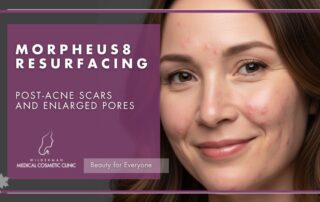 Morpheus8 Resurfacing, Post-Acne Scars and Enlarged Pores